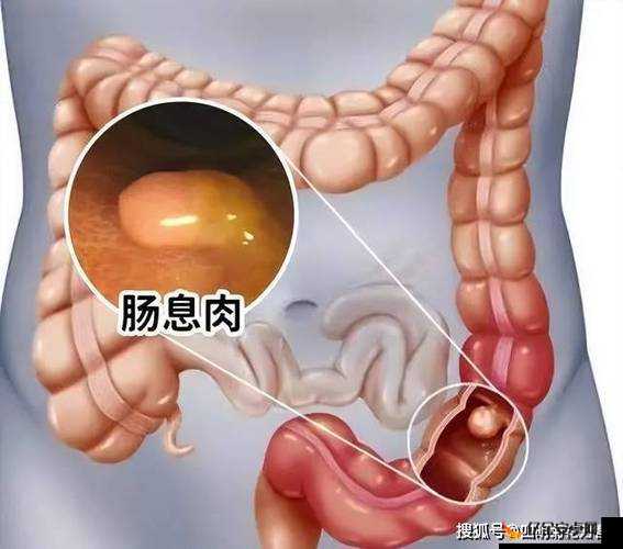 肛門ポリープ 是日语，意思是肛门息肉，这是一种医学病症